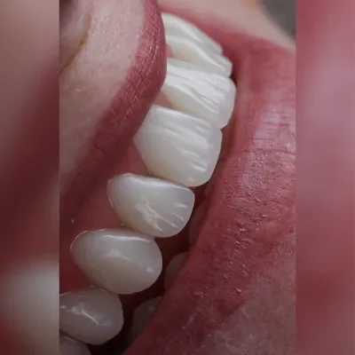 Facetas sem Zoom